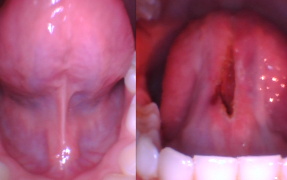 before and after frenectomy at Wildflower Kids Dentistry in Dubuque, IA