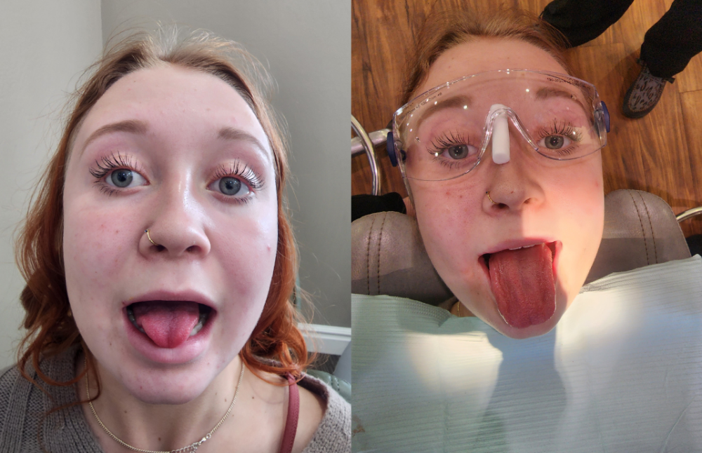kid before and after laser dentistry in Dubuque, IA