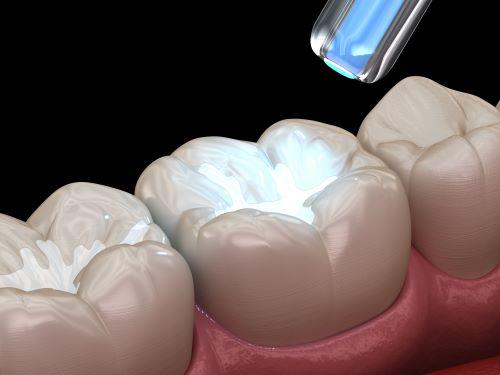Tooth-colored filling procedure | kids dentist Dubuque, IA
