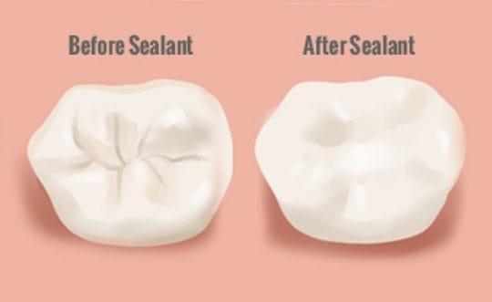 before and after dental sealants in Dubuque, IA